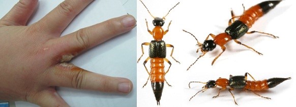 Cách xử lý kiến ba khoang đốt